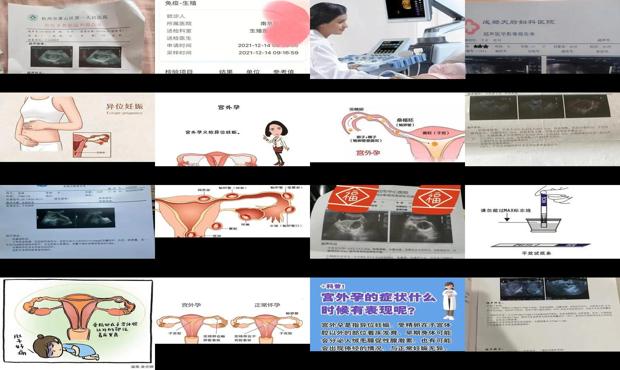 宫劲刮片怎么检查 - 汕头怎么检查宫外孕的位置