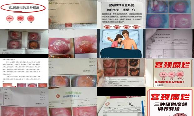汕头宫颈糜烂严重吗