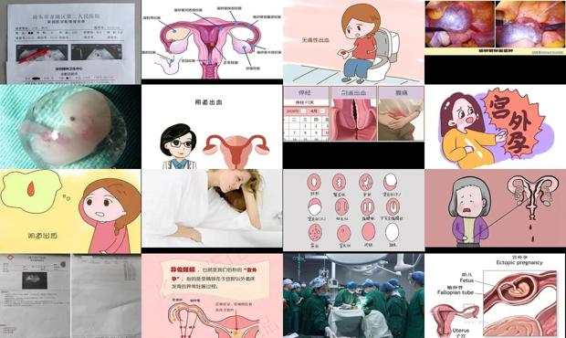 如果是宫外孕阴超检查结果是什么 - 汕头宫外孕阴道会出血吗