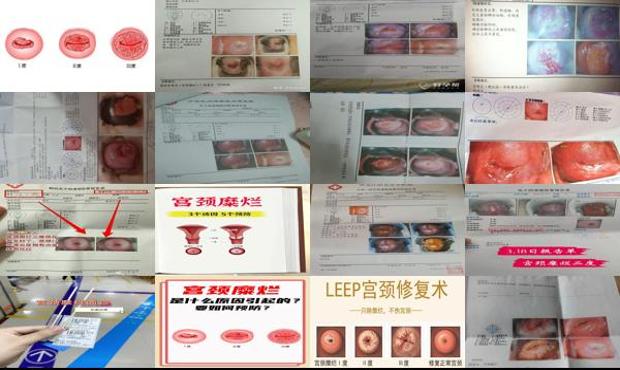 汕头宫颈糜烂怎么检查出来