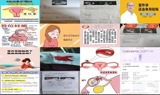 汕头宫外孕回来月经吗