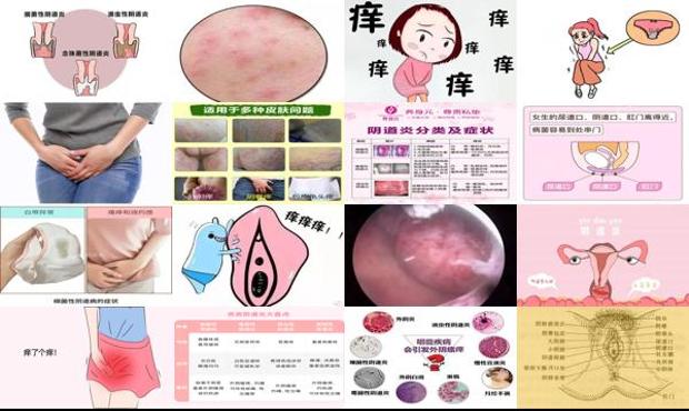 汕头妇科炎症外阴痒