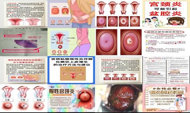 汕头慢性宫颈炎有什么危害
