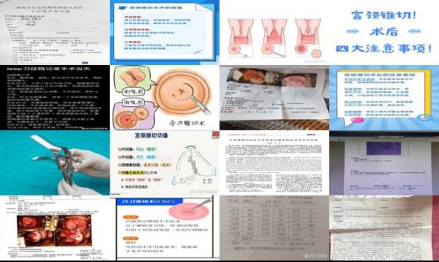 汕头宫颈锥切术费用