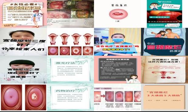 汕头二度宫颈糜烂怎样治*好