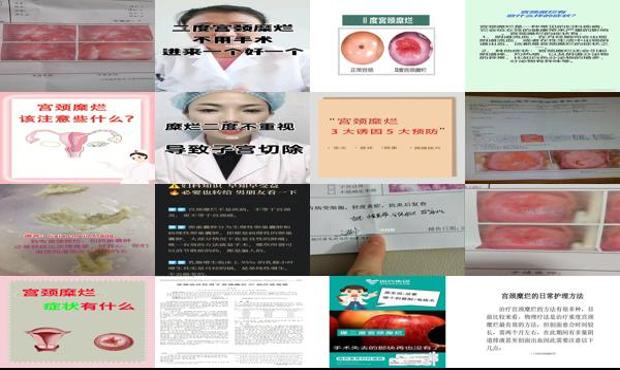 汕头宫颈糜烂2度该怎么办