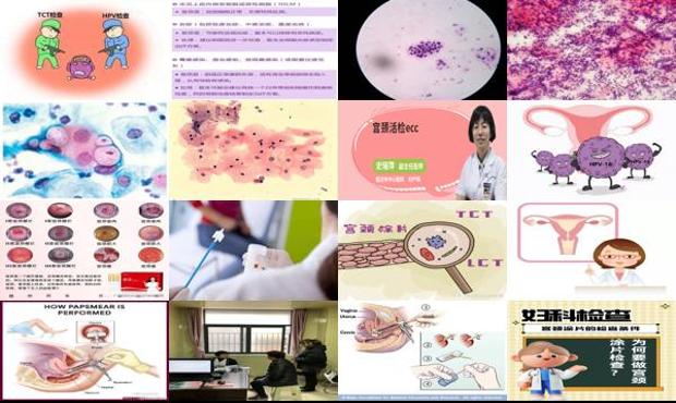汕头宫颈涂片检查