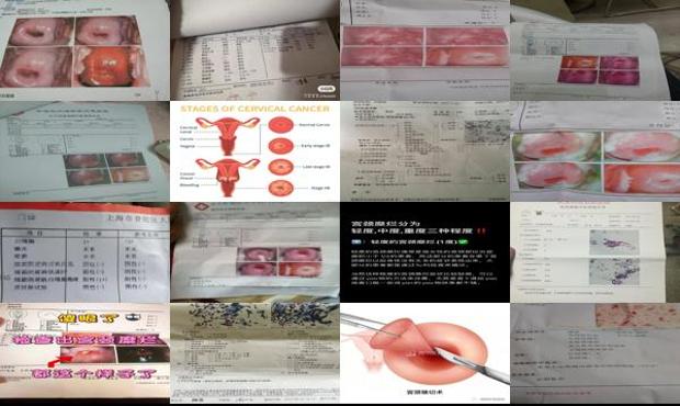 汕头宫颈糜烂检查什么