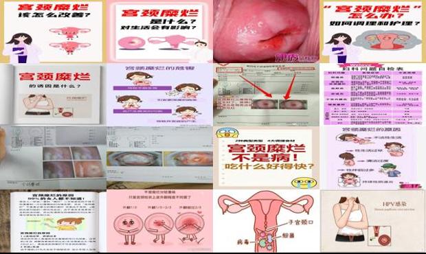 汕头宫颈糜烂是什么原因