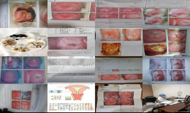 汕头宫颈糜烂b超检查