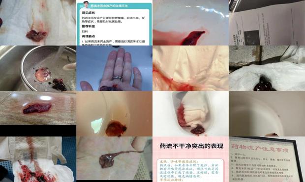 如药流没流干净必须做手术吗? - 汕头药流没流净的症状