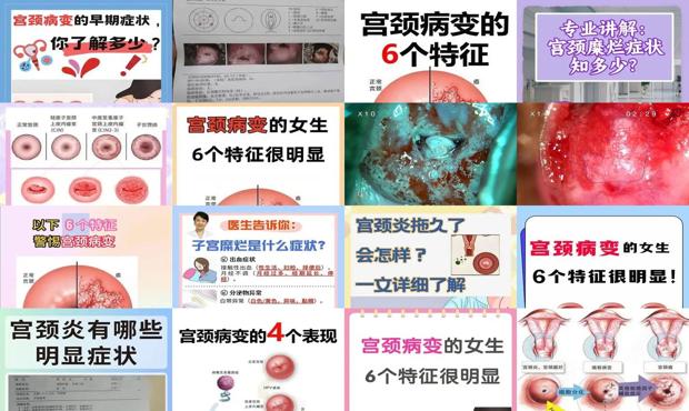汕头宫颈病变有什么症状